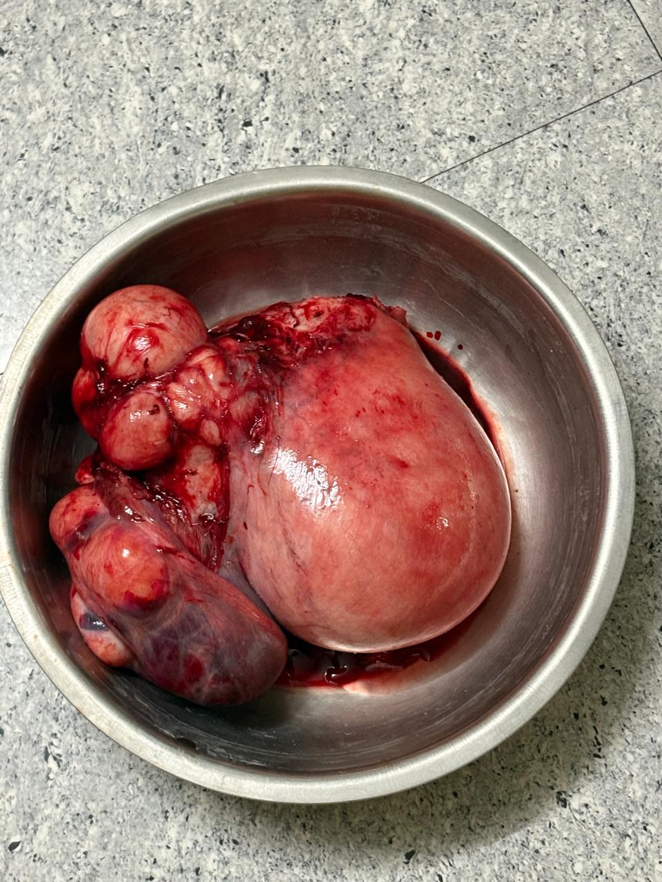 Excised Specimen in Basin - View 2