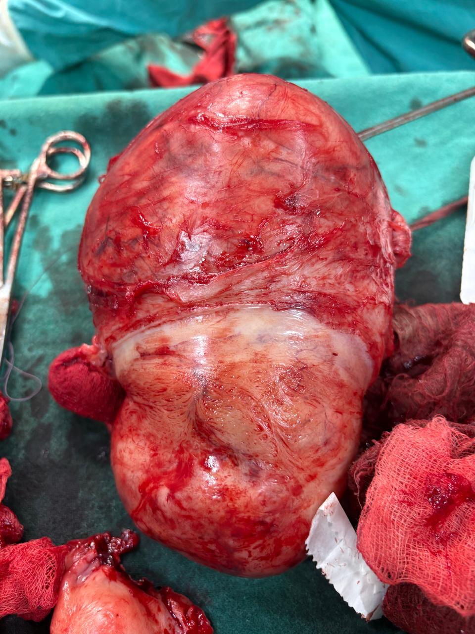 Excised Specimen - View 1